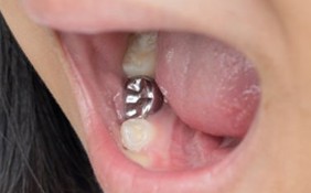 Stainless steel crown treatment for children photo 1